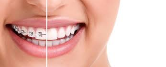 Can I have Teeth Whitening with Braces?