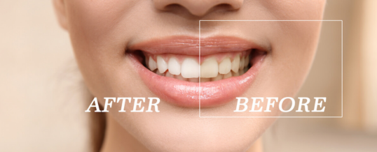 Can yellow teeth become white again?