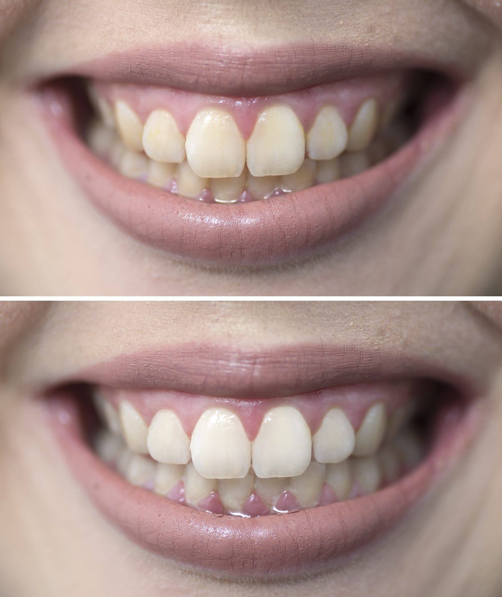 DSC_7123Edit iSmile Professional Teeth Whitening Auckland