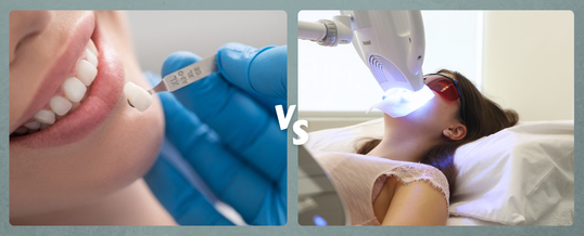 Teeth Whitening vs Dental Veneers